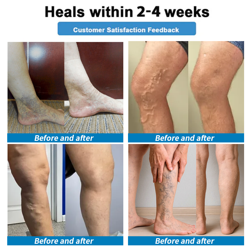 Healrize® 🍃4-in-1 Vein & Joint Nano Microneedle Advanced Therapy Patch🔥Instant Relief, Long-Term Results